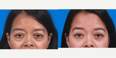 Eyelid Surgery before and after photo
