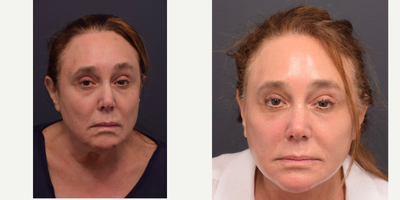 Facelift before and after photo