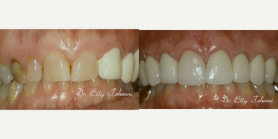 Gum Lift before and after photo