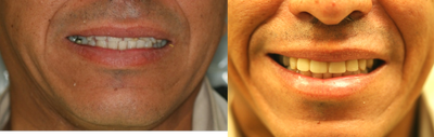 Porcelain Veneers before and after photo