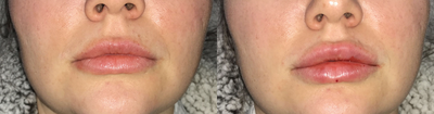 Vollure before and after photo
