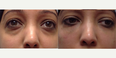 Belotero before and after photo