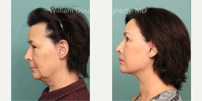 Facelift before and after photo