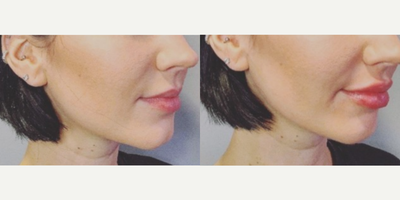 Lip Fillers before and after photo