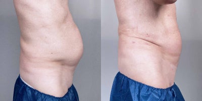Liposuction before and after photo