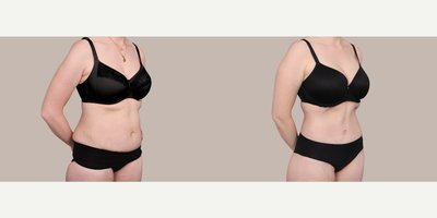 Liposuction before and after photo