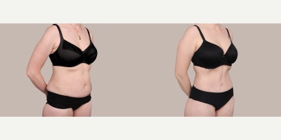 Liposuction before and after photo