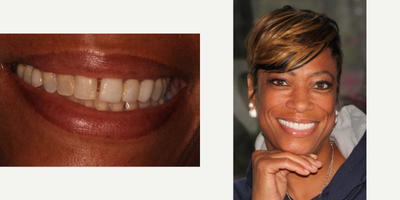 Porcelain Veneers before and after photo