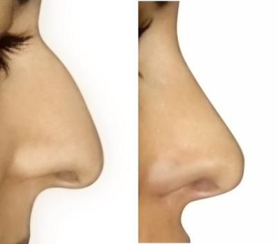 Rhinoplasty before and after photo