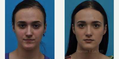 Rhinoplasty before and after photo