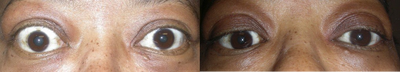 Eyelid Retraction Repair before and after photo