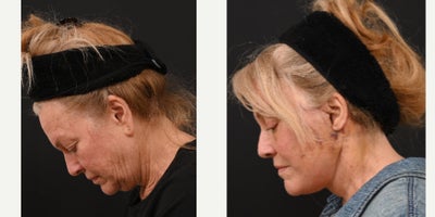 Eyelid Surgery before and after photo