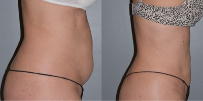 Liposuction before and after photo
