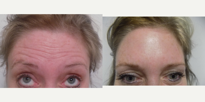 Botox before and after photo