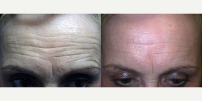 Botox before and after photo