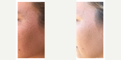 Chemical Peel before and after photo