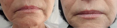 Dermal Fillers before and after photo
