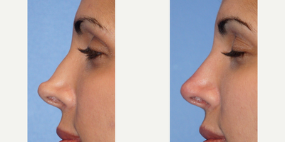 Nonsurgical Nose Job before and after photo