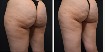 Exilis before and after photo