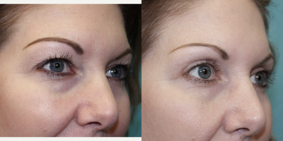 Eyelid Surgery before and after photo
