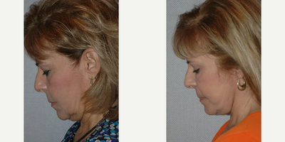 Facelift before and after photo
