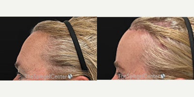 Forehead Reduction before and after photo