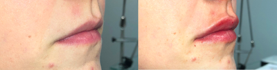 Lip Fillers before and after photo