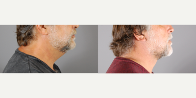 Neck Lift before and after photo