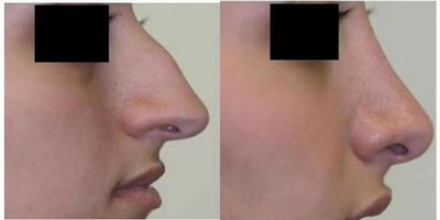 Rhinoplasty before and after photo