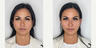 Dermal Fillers before and after photo