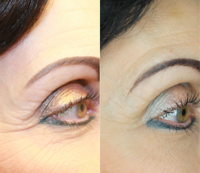 Dysport before and after photo