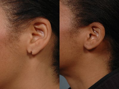 Earlobe Repair before and after photo