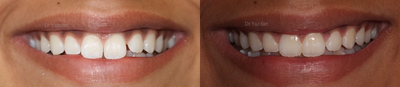 Invisalign before and after photo