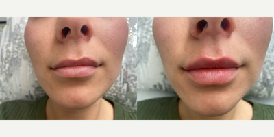 Lip Fillers before and after photo