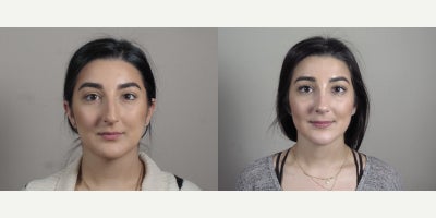 Rhinoplasty before and after photo