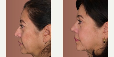 Rhinoplasty before and after photo