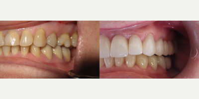 Dental Crown before and after photo