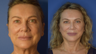 Facelift before and after photo