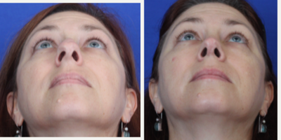 Rhinoplasty before and after photo