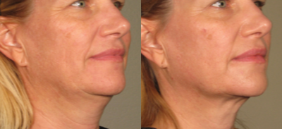 Ultherapy before and after photo