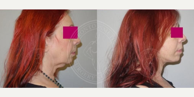 Facelift before and after photo