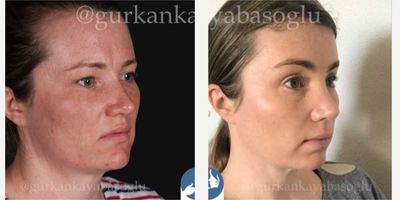 Forehead Reduction before and after photo