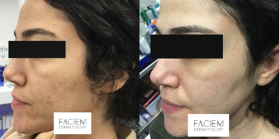 HydraFacial before and after photo