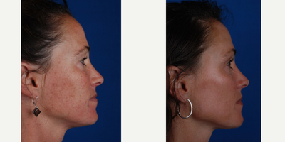 IPL before and after photo