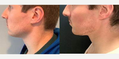 Kybella before and after photo