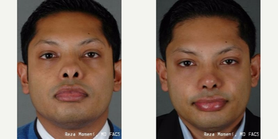 Rhinoplasty before and after photo