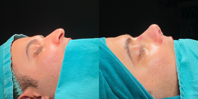 Rhinoplasty before and after photo