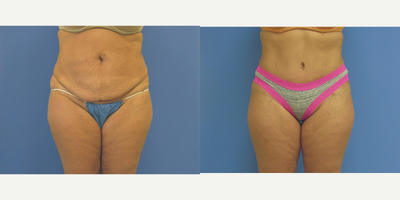 Tummy Tuck before and after photo
