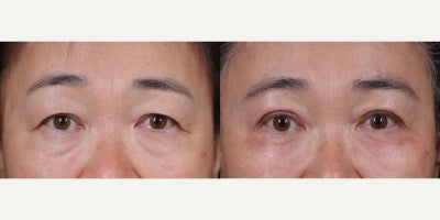 Brow Lift before and after photo