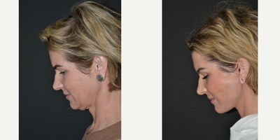 Deep Plane Facelift before and after photo